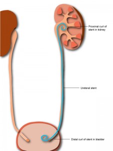 Diagram of a ureteral stent in position.